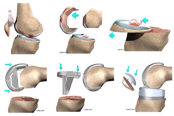 TKA_procedure