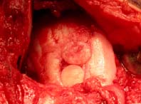 mosaicplasty